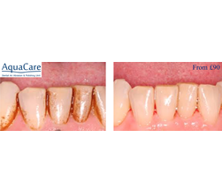 Aquacare Before And After Image